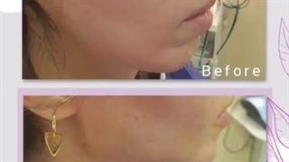 تزریق چربی و زاویه سازی فک