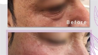 رفع تیرگى و گودى زیر چشم با تزریق ژل زیر چشم و نخ