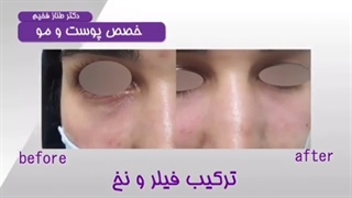 ترکیب فیلر و نخ