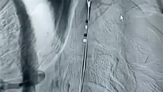 درمان آنژیوپلاستی بیمار سکته مغزی توسط دکتر مجید کیهانی فرد