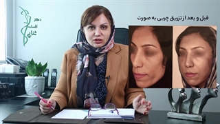فیلم تزریق چربی به صورت