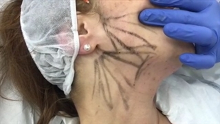 آموزش تزریق جوانساز پروسترولین