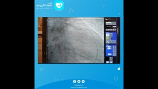 آنژیوپلاستی بیمار با تنگی شدید عروق قلبی