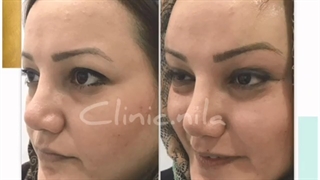 لیفت شقیقه و اصلاح فرم چشم ها