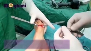 عمل بدون سانسور جراحی هالوکس والگوس