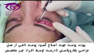 اصلاح پوست بعد از بلفاروپلاستی نادرست توسط افراد غیرمتخصص