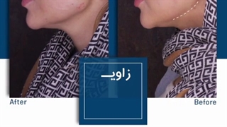 زاویه سازی صورت