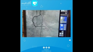 آنژیوپلاستی رگ مسدود شده در بیمار با درد در بالای شکم