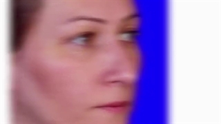 عمل همزمان زیبایی بینی و جراحی بلفاروپلاستی