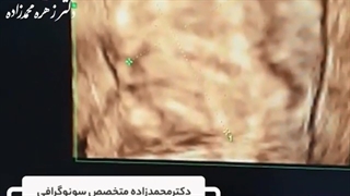 سونوگرافى چهار بعدى که داخل آندومتر انجام شده