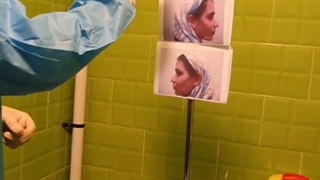 جراحی بینی کاملا گوشتی توسط دکتر اصحاب یمین لیفت صورت