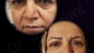 جراحی زیبایی پلک فوقانی همراه با لیفت خفیف ابرو