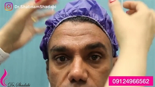 لیفت اندوسکوپیک ابرو و پروتز گونه