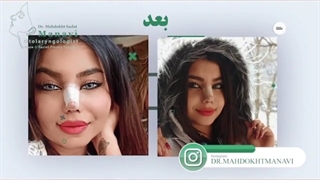 جراحی بینی گوشتی