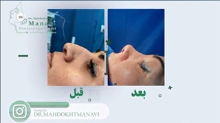 جراحی بینی استخوانی قوزدار زنانه