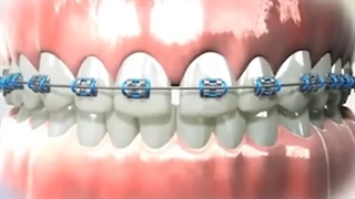 جراحی فرنوم ( فرنکتومی ) | کلینیک تخصصی دندانپزشکی کانسپتا