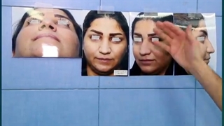 جراحی زیبایی بینی