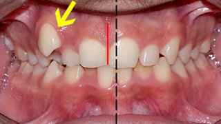 درمان ارتودنسی ثابت دو فک بدون کشیدن دندان | کلینیک تخصصی دندانپزشکی کانسپتا