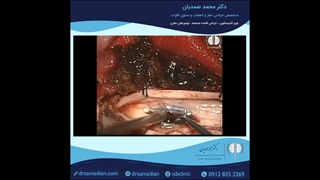 عمل جراحی ضایعه عروقی (همانژیوم کاورنوس) نخاع گردن