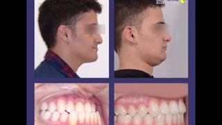 نمونه کارهای قبل و بعد از درمان ارتودنسی / متخصص ارتودنسی / دکتر جمیلیان