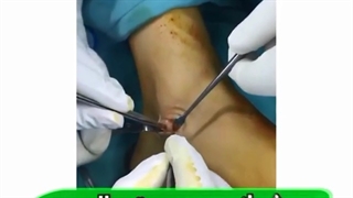 فیلم جراحی پیوند عصب