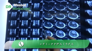 فیلم واقعی جراحی تومور استخوان