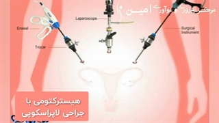 هیستروکتومی با جراحی لاپاراسکوپی