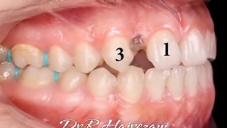 فضای بسته شده ناشی از فقدان مادرزادی دندان لترال (پیشین طرفی) | کلینیک کانسپتا