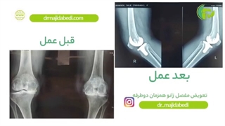 فیلم بدون سانسور تعویض مفصل زانو همزمان دو طرفه