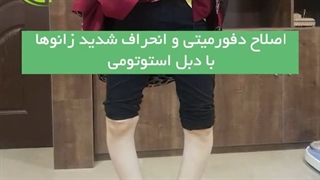 فیلم بدون سانسور اصلاح دفورمیتی و انحراف شدید زانوها با دبل استوتومی