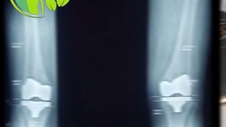 فیلم تعویض همزمان مفصل دو زانو