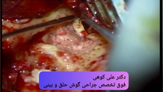 کلستاتوم یا کیست گوش