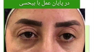 عمل جراحی بلفاروپلاستی پلک بالا
