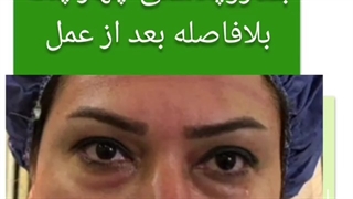 بلفاروپلاستی 4 پلک