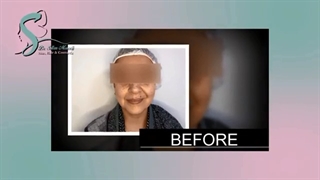 فیلم تزریق ژل و لیفت صورت با نخ