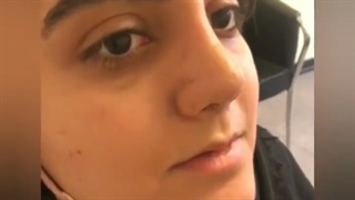 دو هفته بعد از جراحی زیبایی بینی