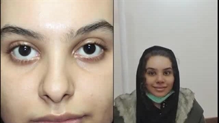 5 روز بعد از عمل بینی
