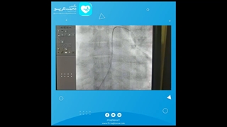 آنژیوپلاستی شریان های ریوی برای درمان آمبولی ریه