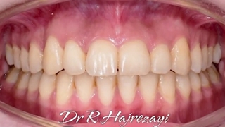 درمان ارتودنسی ثابت دو فک بدون کشیدن دندان | کلینیک تخصصی دندانپزشکی کانسپتا