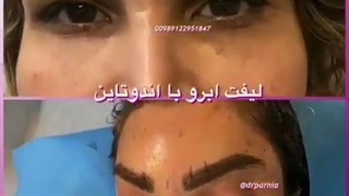 لیفت ابرو اندوتاین