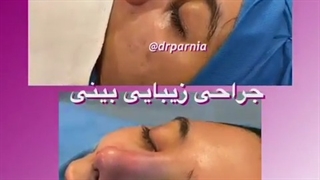 جراحی بینی_عمل بینی