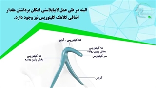 لابیاپلاستی