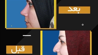 فیلم رینوپلاستی و بلفاروپلاستی به طور همزمان