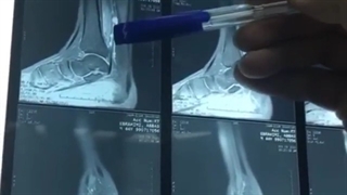 فیلم واقعی خارج سازی تومور فیبروسارکوم استخوان