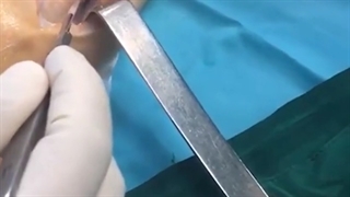 فیلم واقعی پیوند عصب ساق پا