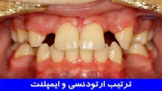 ترتیب ارتودنسی و ایمپلنت | دکتر احسان مهریزی
