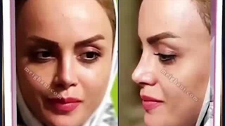 نمونه کارهای جراحی بینی دکتر میقانی