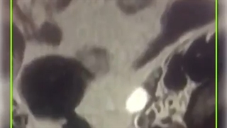 هیدروسالپنکس