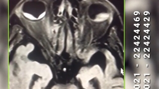 صحبت های دکتر نوید توفیقی راد درباره Retinal haemorrhage