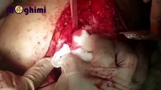 فیلم بدون سانسور عمل شکستگی فمور و پروتزگذاری مفصل ران